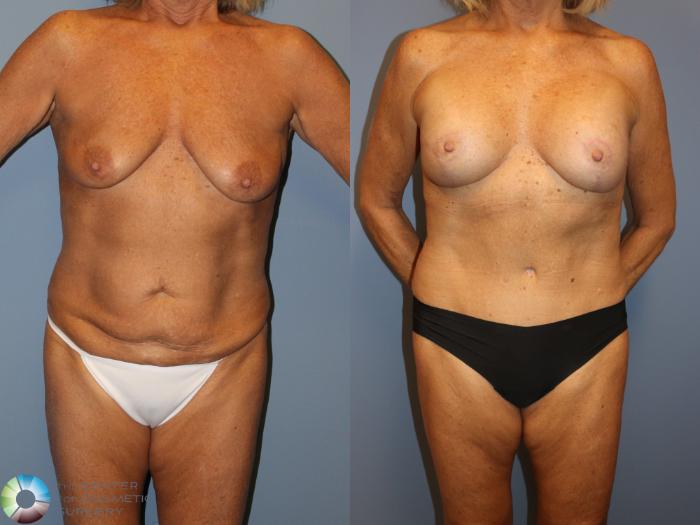 Before & After Breast Lift Case 12062 Front in Denver and Colorado Springs, CO