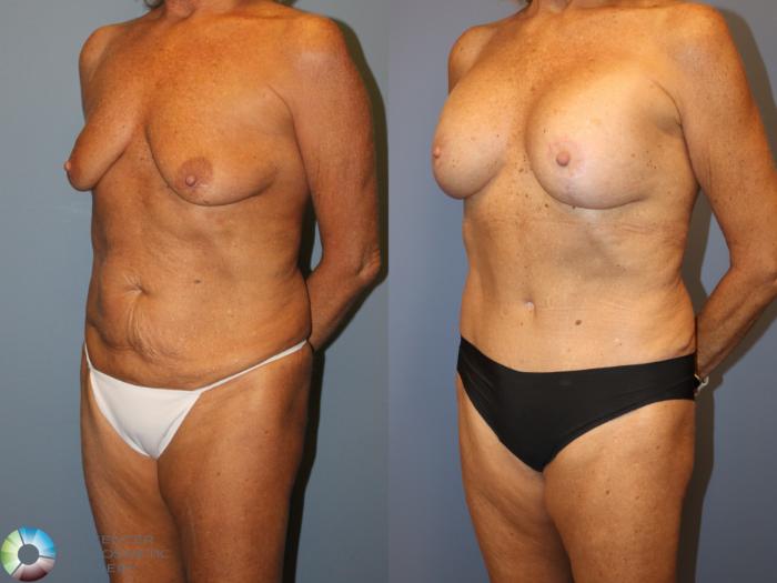 Before & After Breast Lift Case 12062 Left Oblique in Denver and Colorado Springs, CO