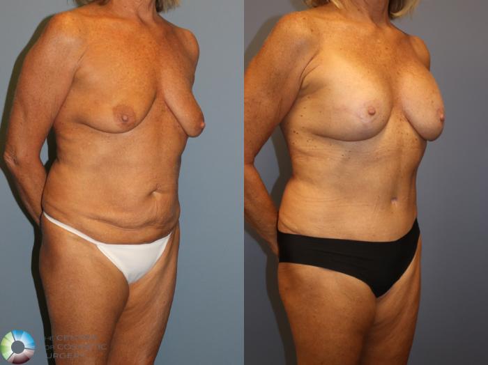 Before & After Breast Lift Case 12062 Right Oblique in Denver and Colorado Springs, CO