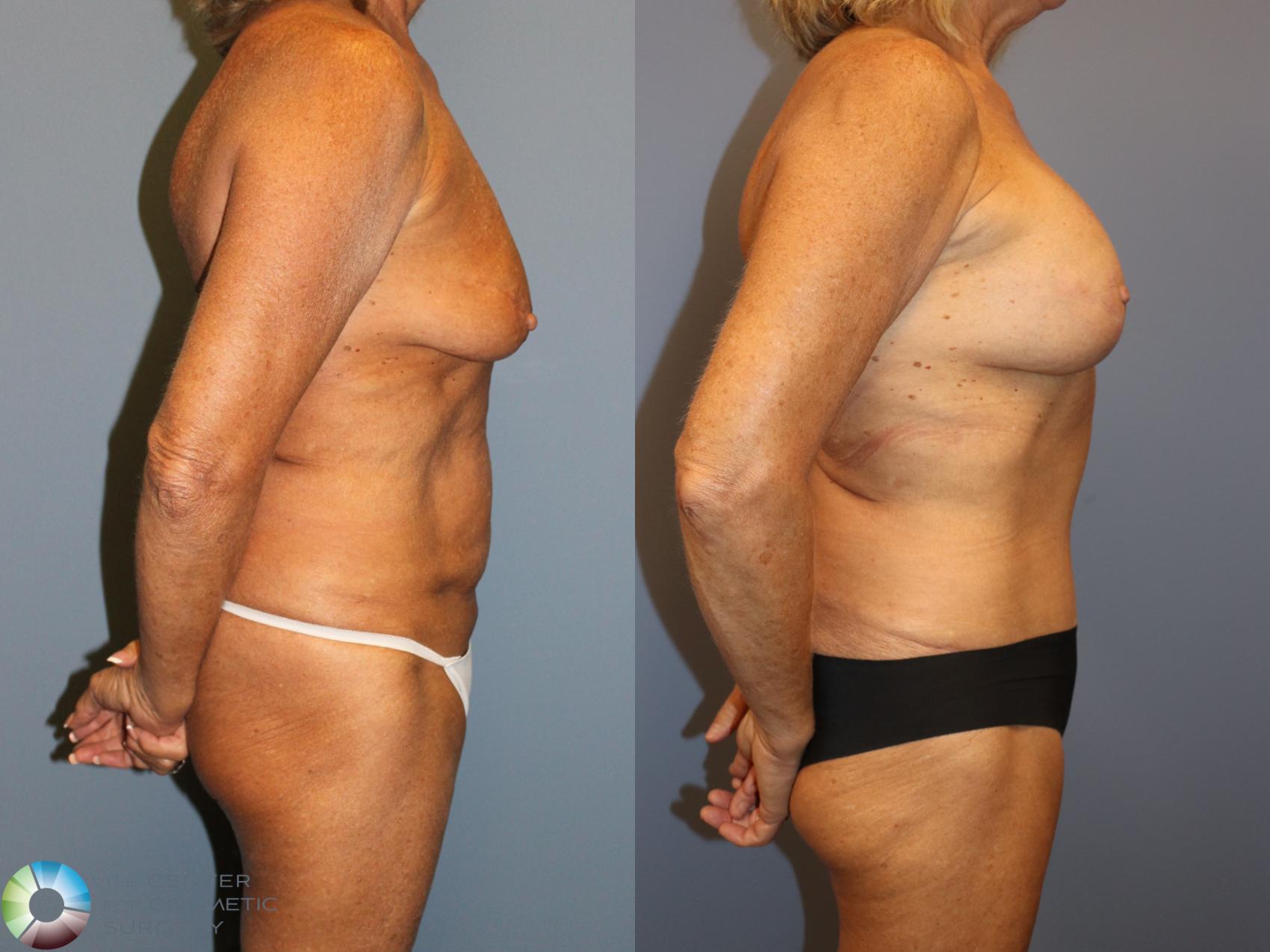 Before & After Mommy Makeover Case 12062 Right Side in Denver and Colorado Springs, CO