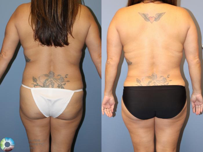 Before & After Breast Lift Case 12065 Back in Denver and Colorado Springs, CO