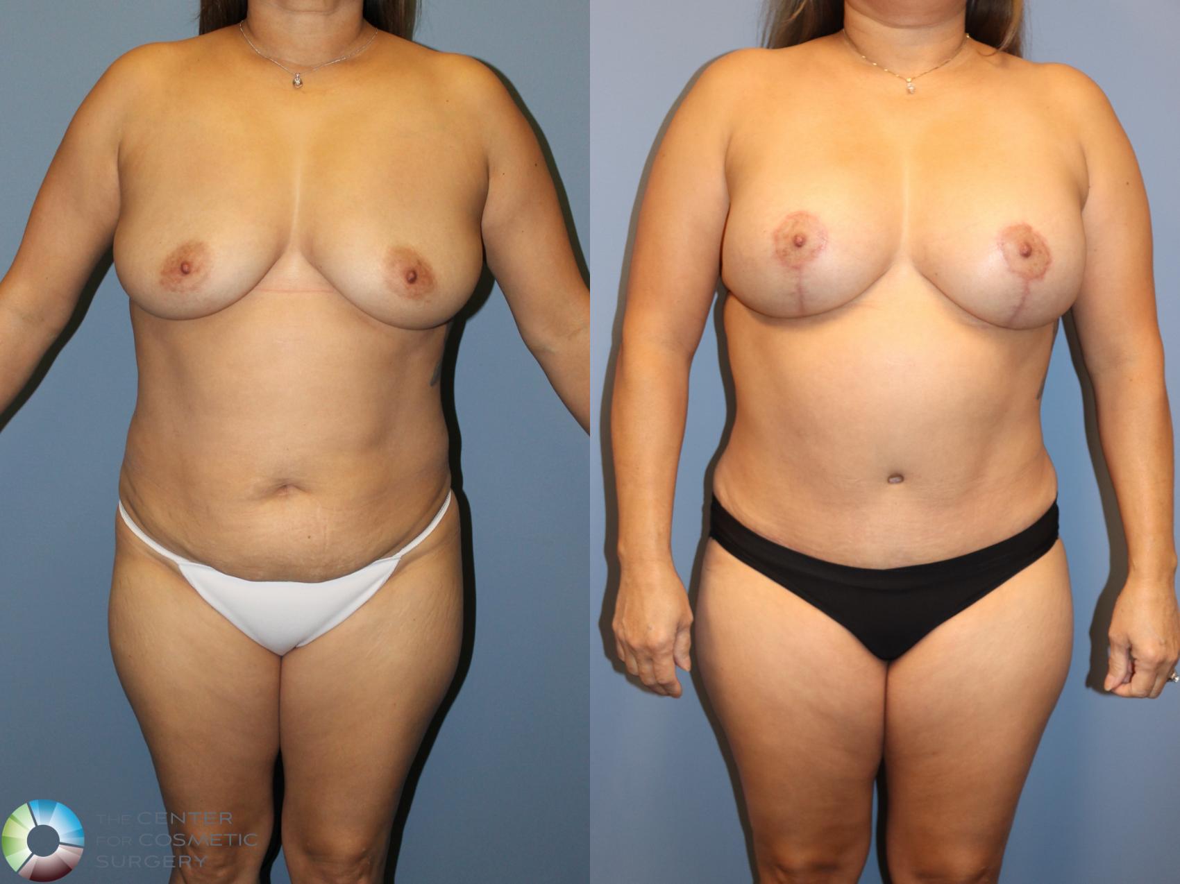 Before & After Breast Lift Case 12065 Front in Denver and Colorado Springs, CO