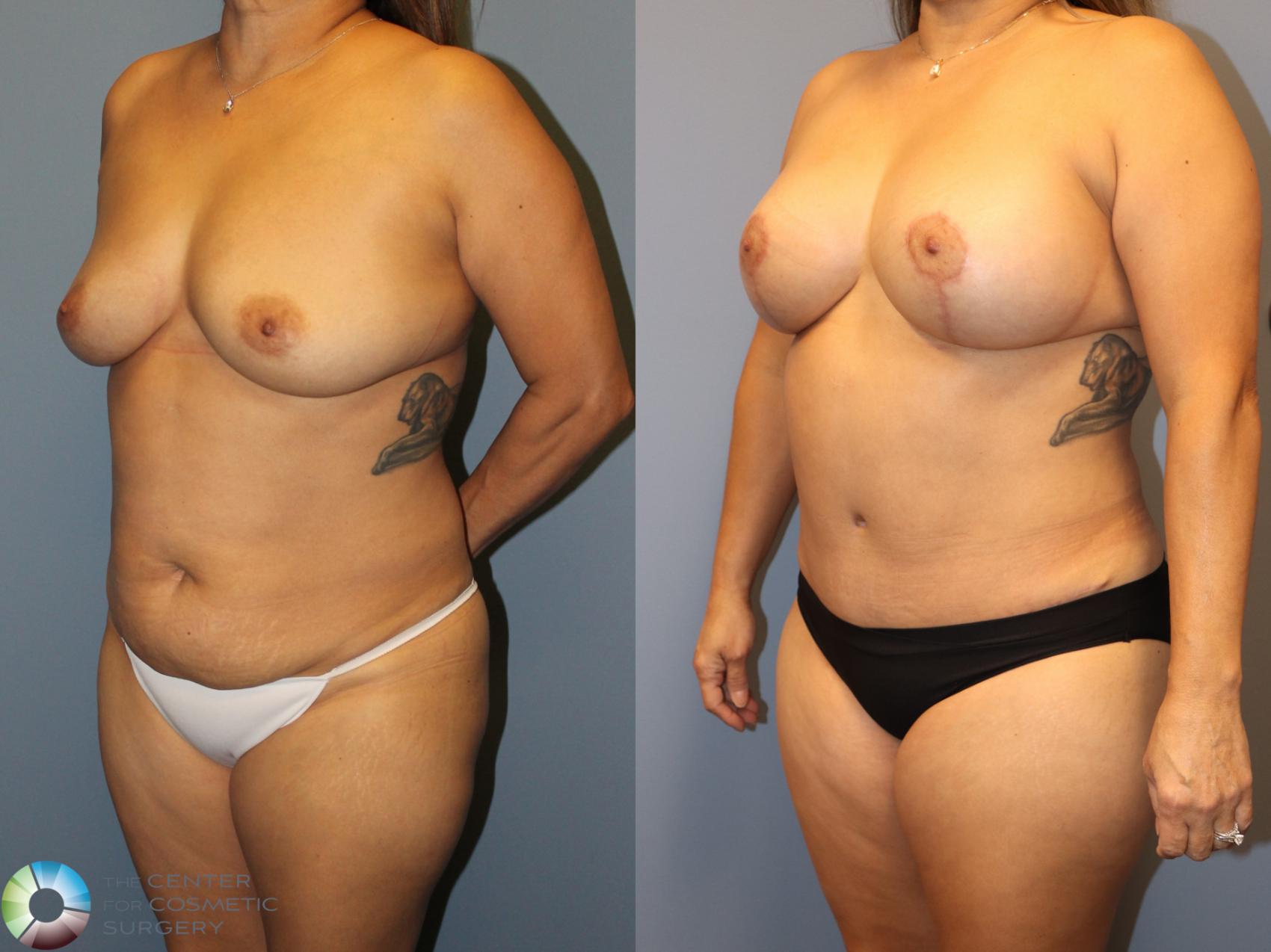 Before & After Mommy Makeover Case 12065 Left Oblique in Denver and Colorado Springs, CO