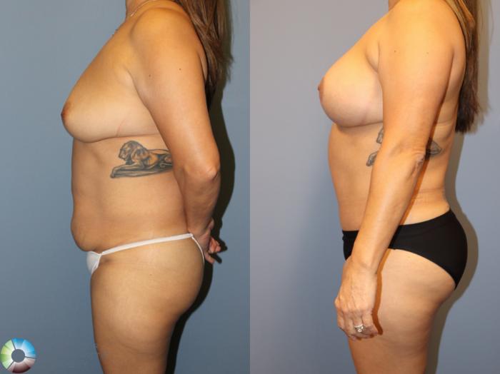 Before & After Power-Assisted Liposuction Case 12065 Left Side in Denver and Colorado Springs, CO