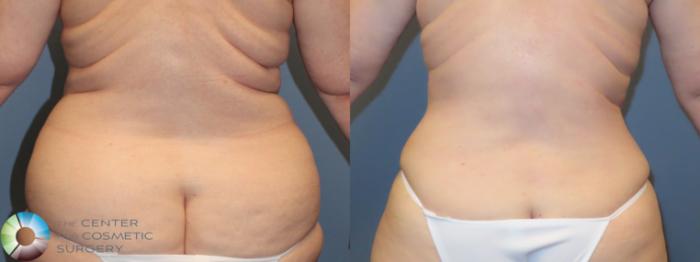 Best Denver Mommy Makeover