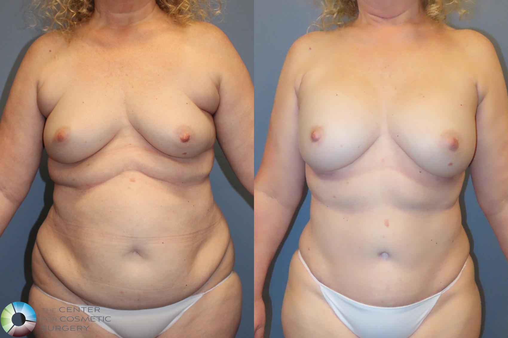 Best Denver Mommy Makeover
