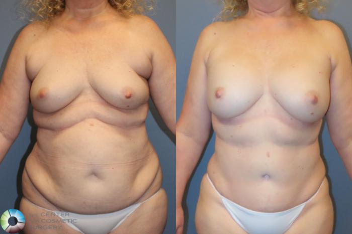 Best Denver Mommy Makeover