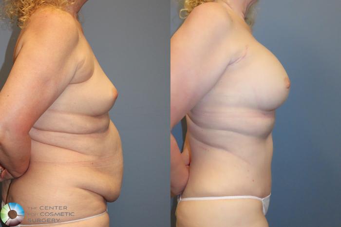 Best Denver Mommy Makeover