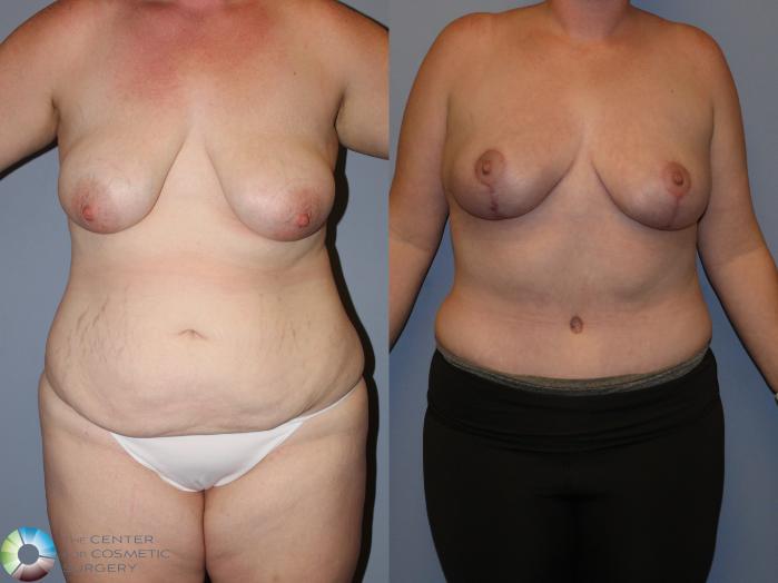 Before & After Tummy Tuck Case 12105 Front in Denver and Colorado Springs, CO