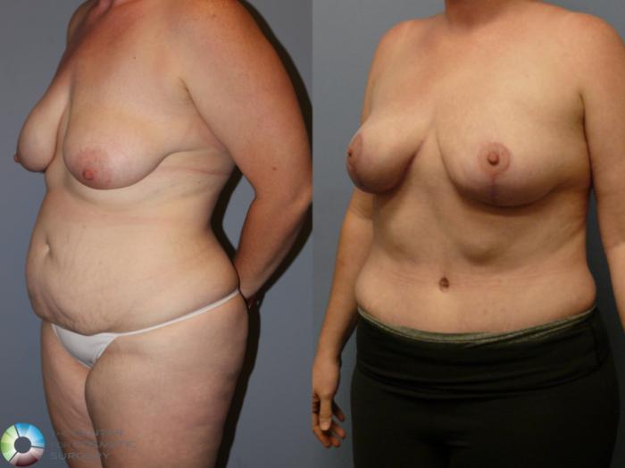 Before & After Tummy Tuck Case 12105 Left Oblique in Denver and Colorado Springs, CO