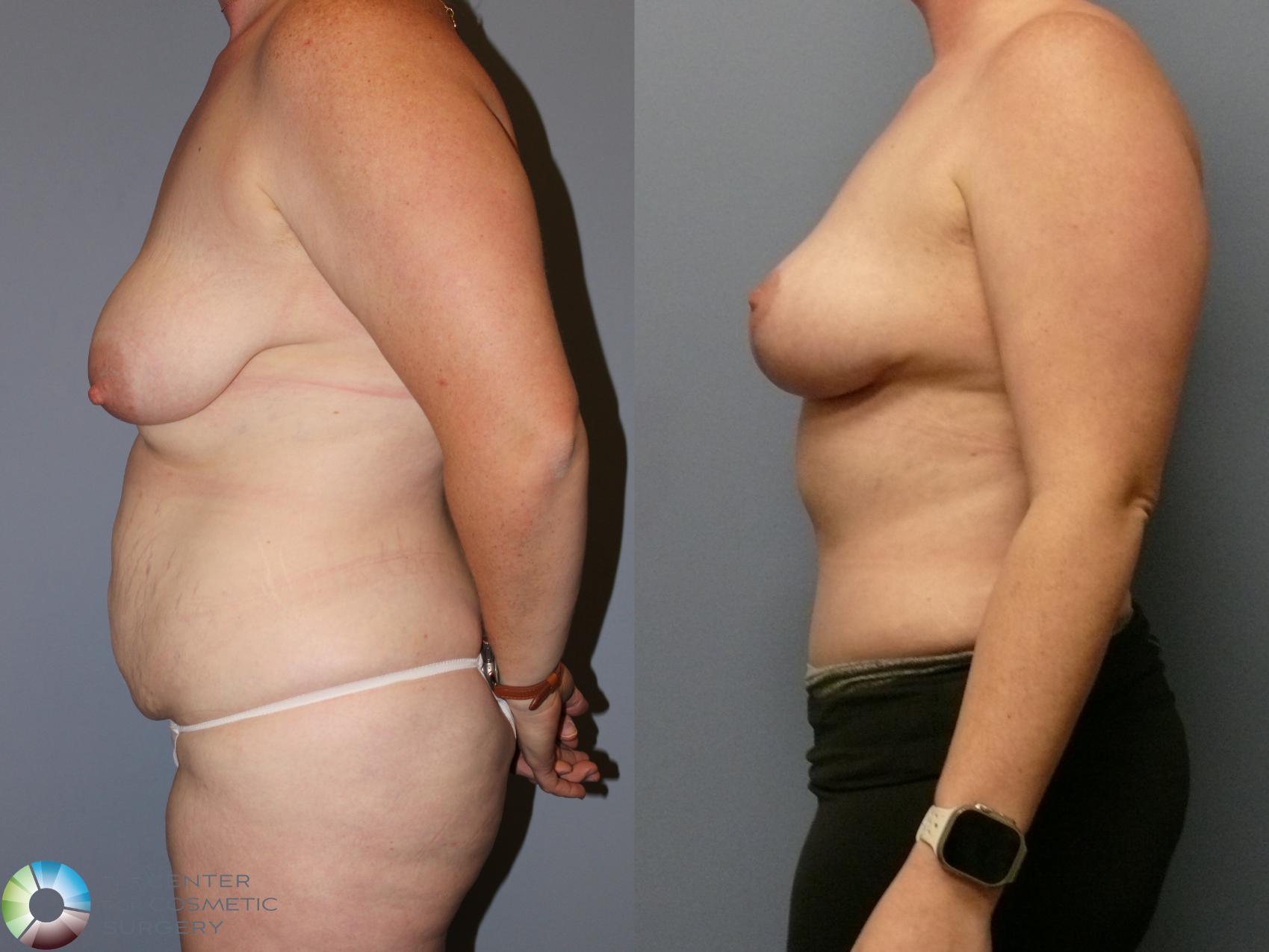 Before & After Tummy Tuck Case 12105 Left Side in Denver and Colorado Springs, CO