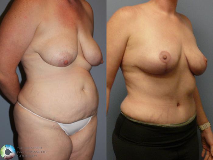 Before & After Tummy Tuck Case 12105 Right Oblique in Denver and Colorado Springs, CO