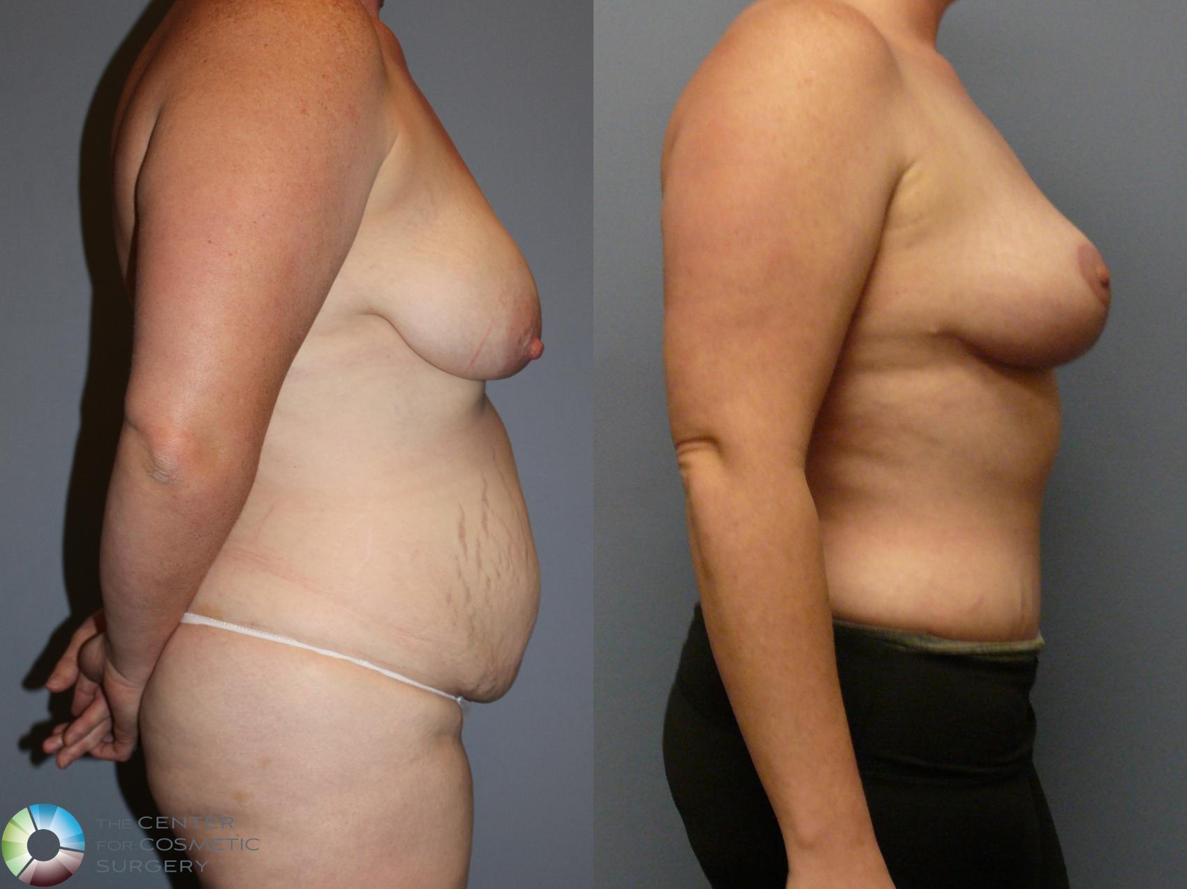 Before & After Mommy Makeover Case 12105 Right Side in Denver and Colorado Springs, CO