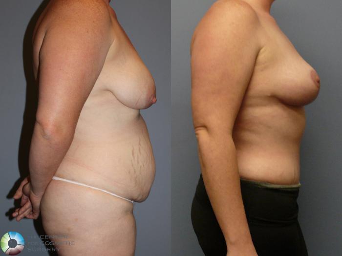 Before & After Tummy Tuck Case 12105 Right Side in Denver and Colorado Springs, CO