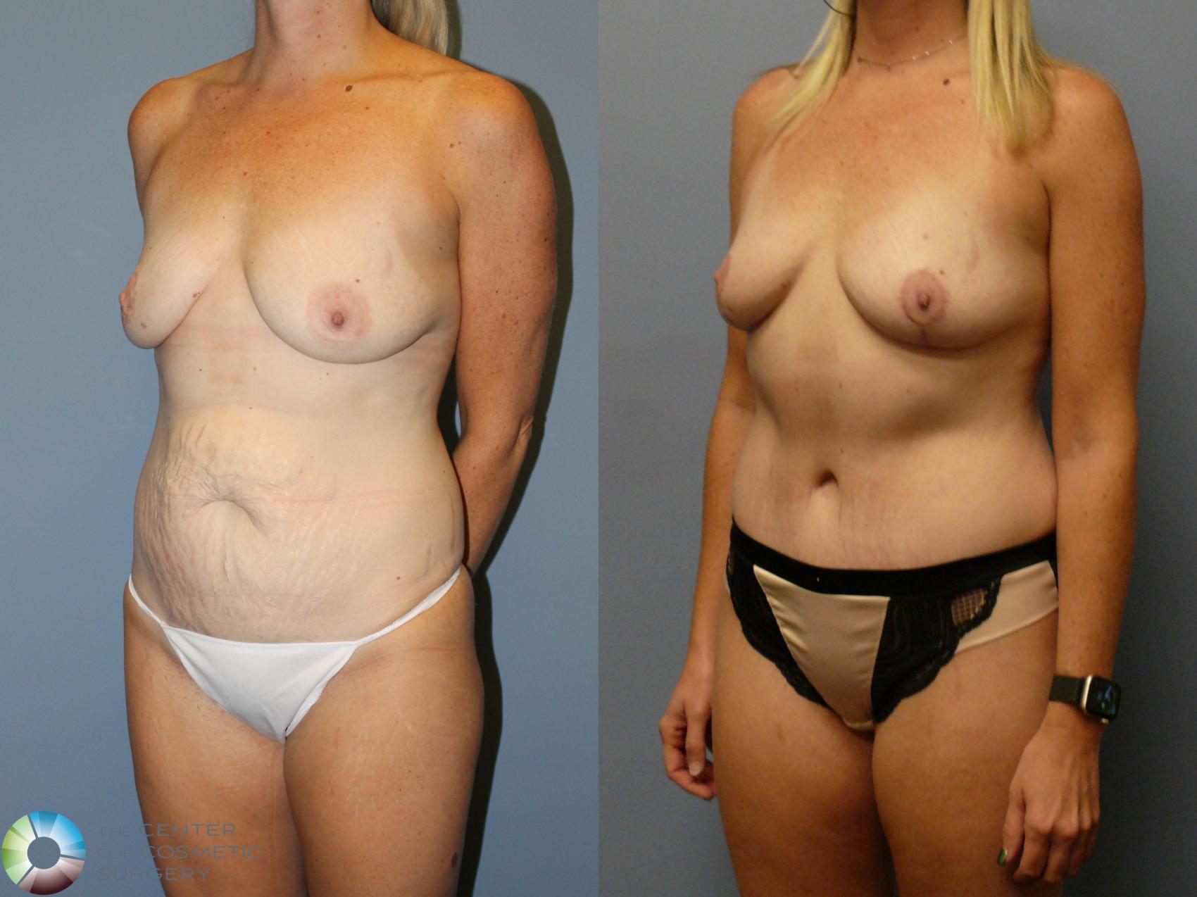 Before & After Mommy Makeover Case 12106 Left Oblique in Denver and Colorado Springs, CO