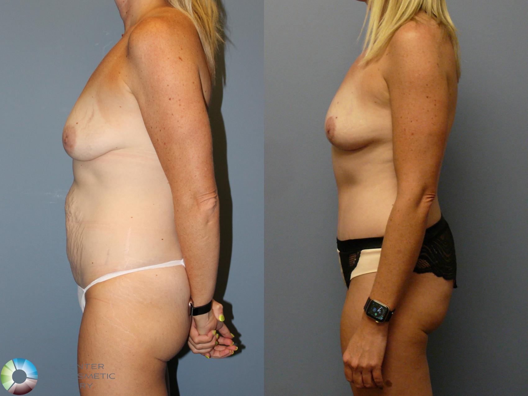 Before & After Mommy Makeover Case 12106 Left Side in Denver and Colorado Springs, CO