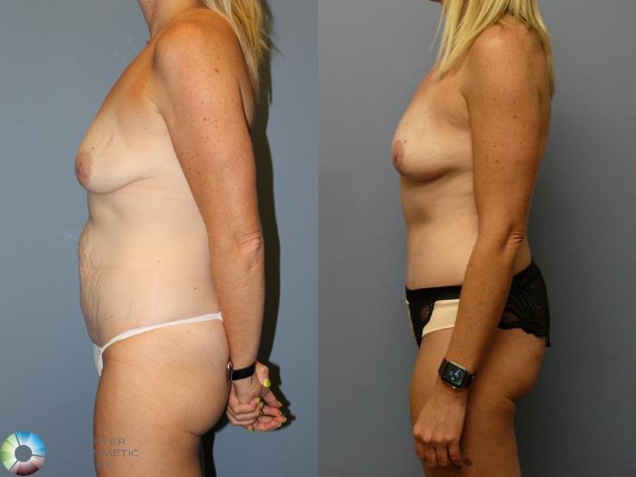 Before & After Tummy Tuck Case 12106 Left Side in Denver and Colorado Springs, CO