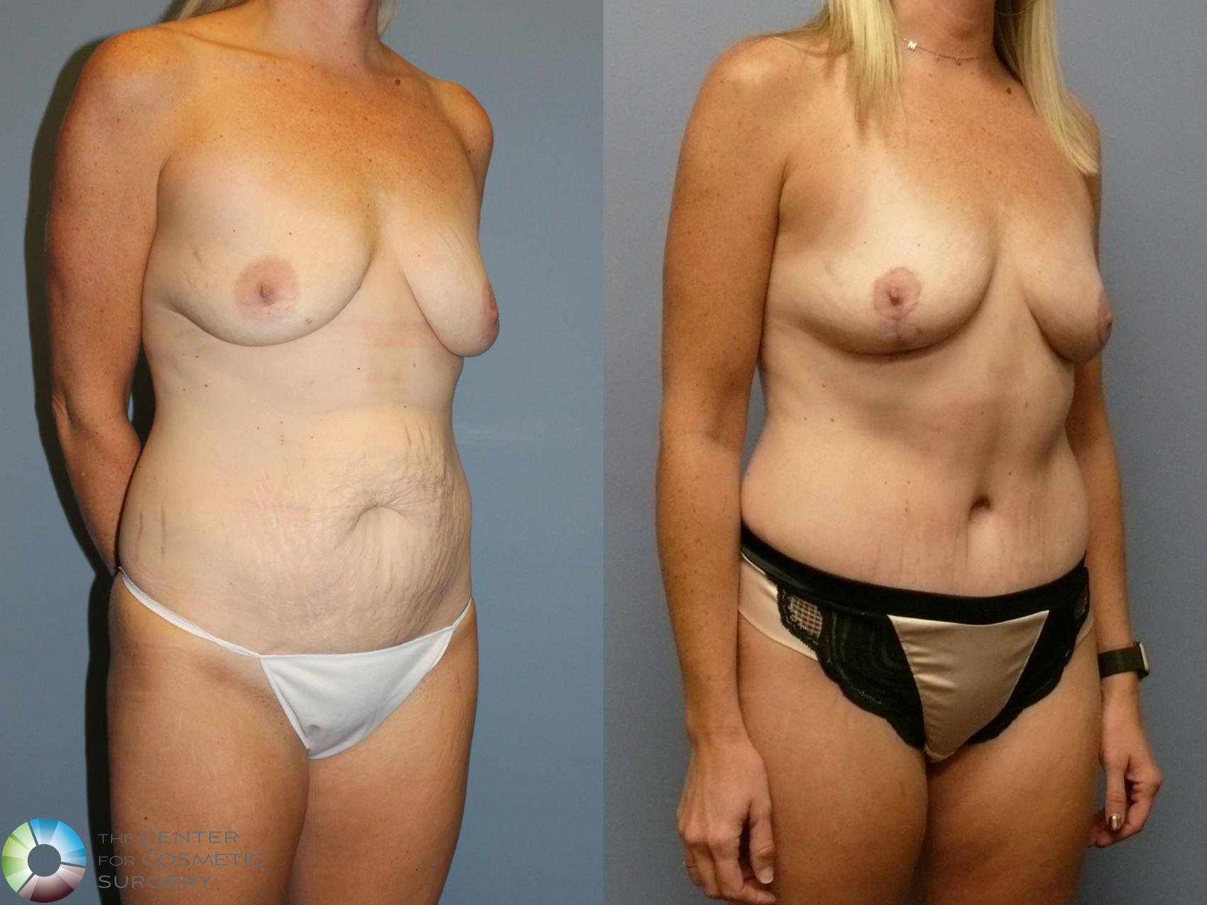 Before & After Mommy Makeover Case 12106 Right Oblique in Denver and Colorado Springs, CO