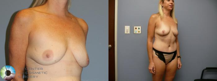 Before & After Tummy Tuck Case 12106 Right Oblique in Denver and Colorado Springs, CO