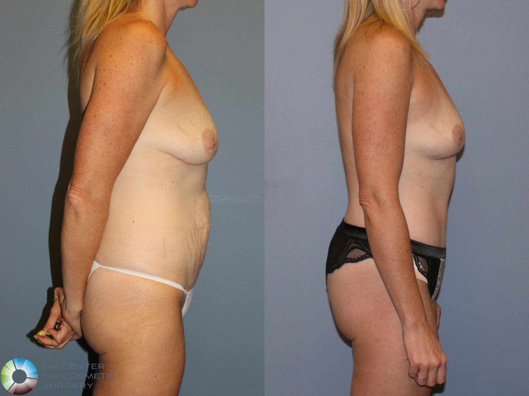 Before & After Mommy Makeover Case 12106 Right Side in Denver and Colorado Springs, CO