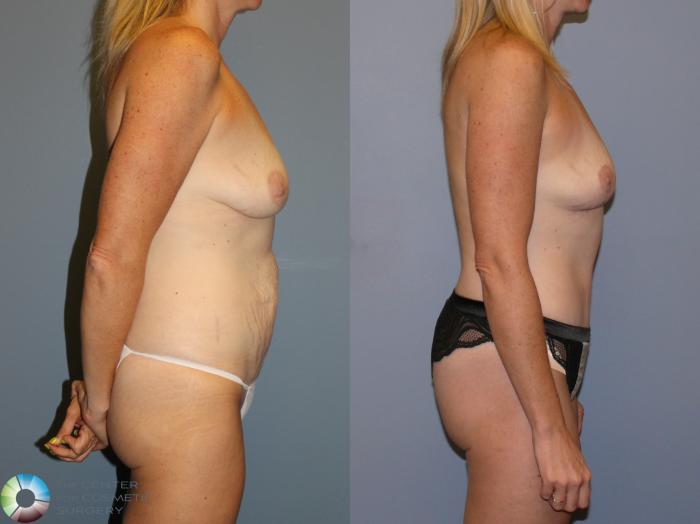 Before & After Tummy Tuck Case 12106 Right Side in Denver and Colorado Springs, CO