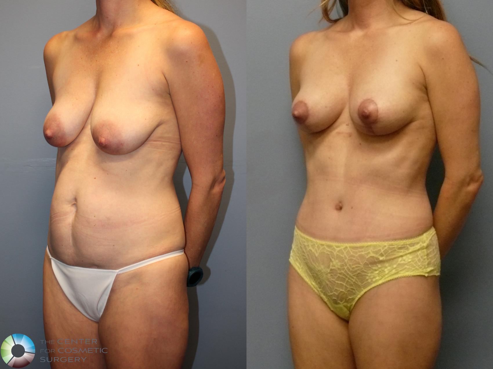 Before & After Mommy Makeover Case 12109 Left Oblique in Denver and Colorado Springs, CO