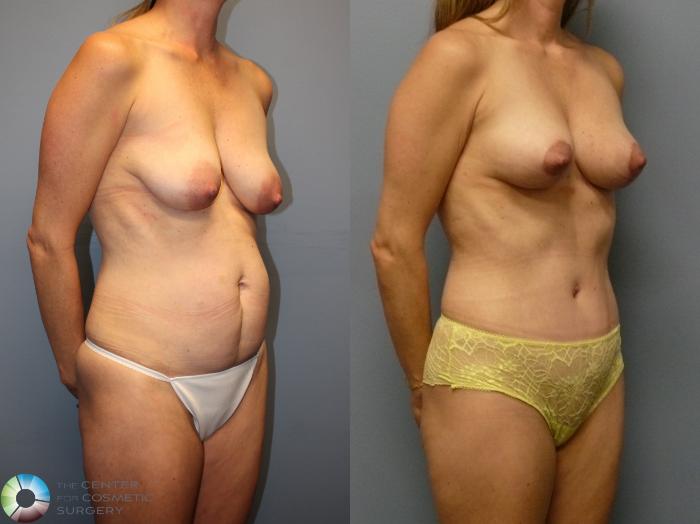 Before & After Breast Lift Case 12109 Right Oblique in Denver and Colorado Springs, CO