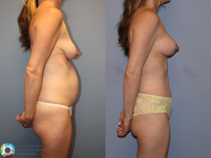 Before & After Breast Lift Case 12109 Right Side in Denver and Colorado Springs, CO