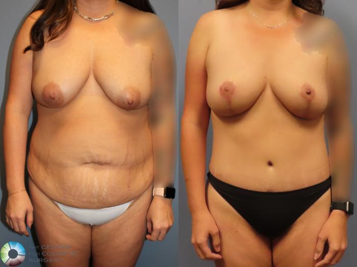 Before & After Liposuction Case 12121 Front in Denver and Colorado Springs, CO