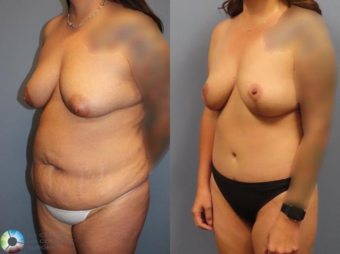 Before & After Liposuction Case 12121 Left Oblique in Denver and Colorado Springs, CO