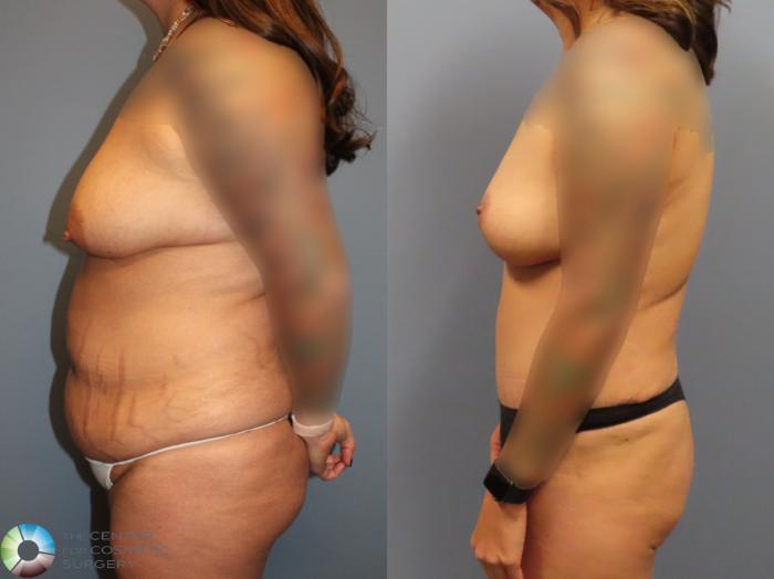 Before & After Liposuction Case 12121 Left Side in Denver and Colorado Springs, CO