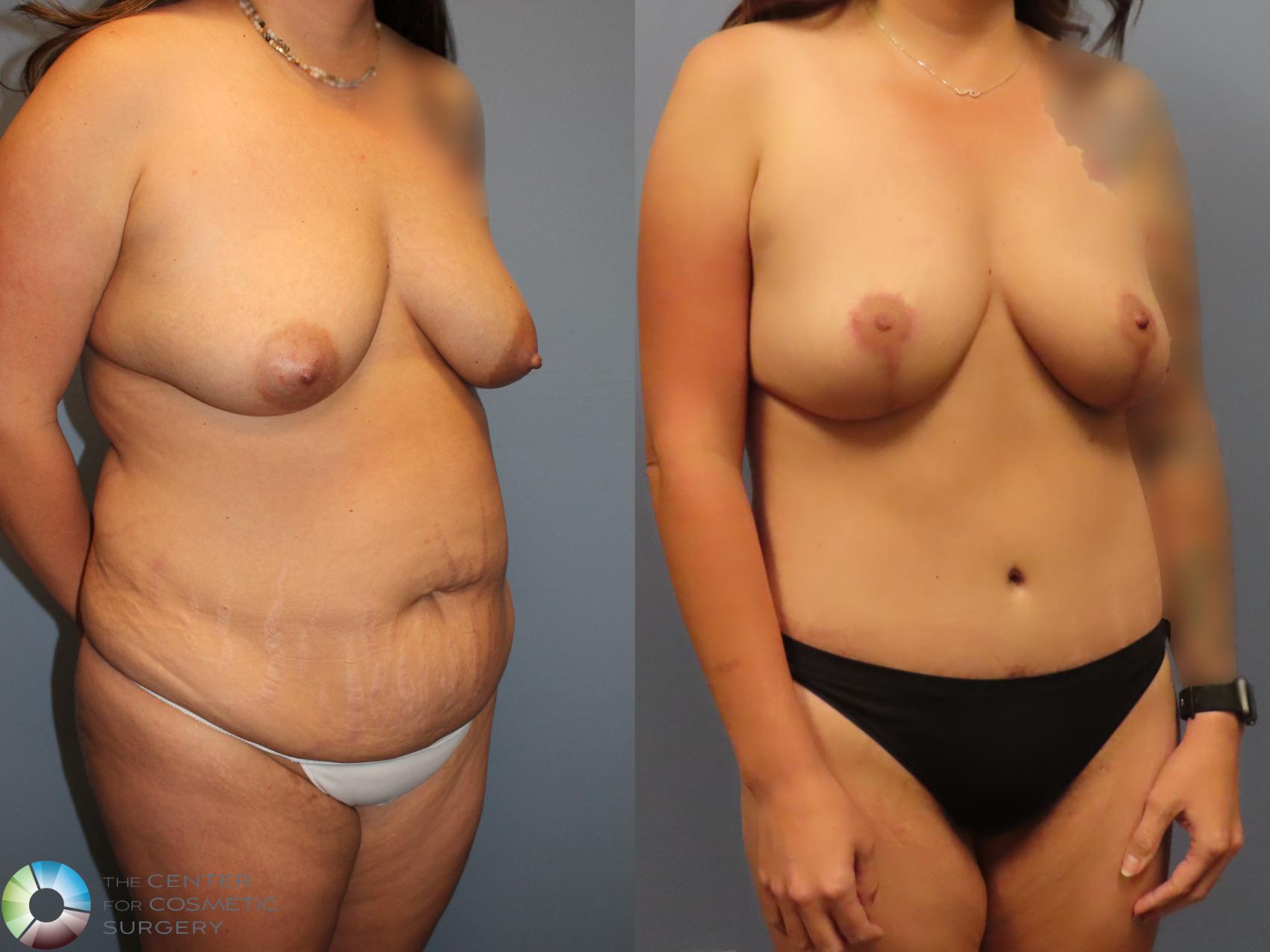 Before & After Mommy Makeover Case 12121 Right Oblique in Denver and Colorado Springs, CO