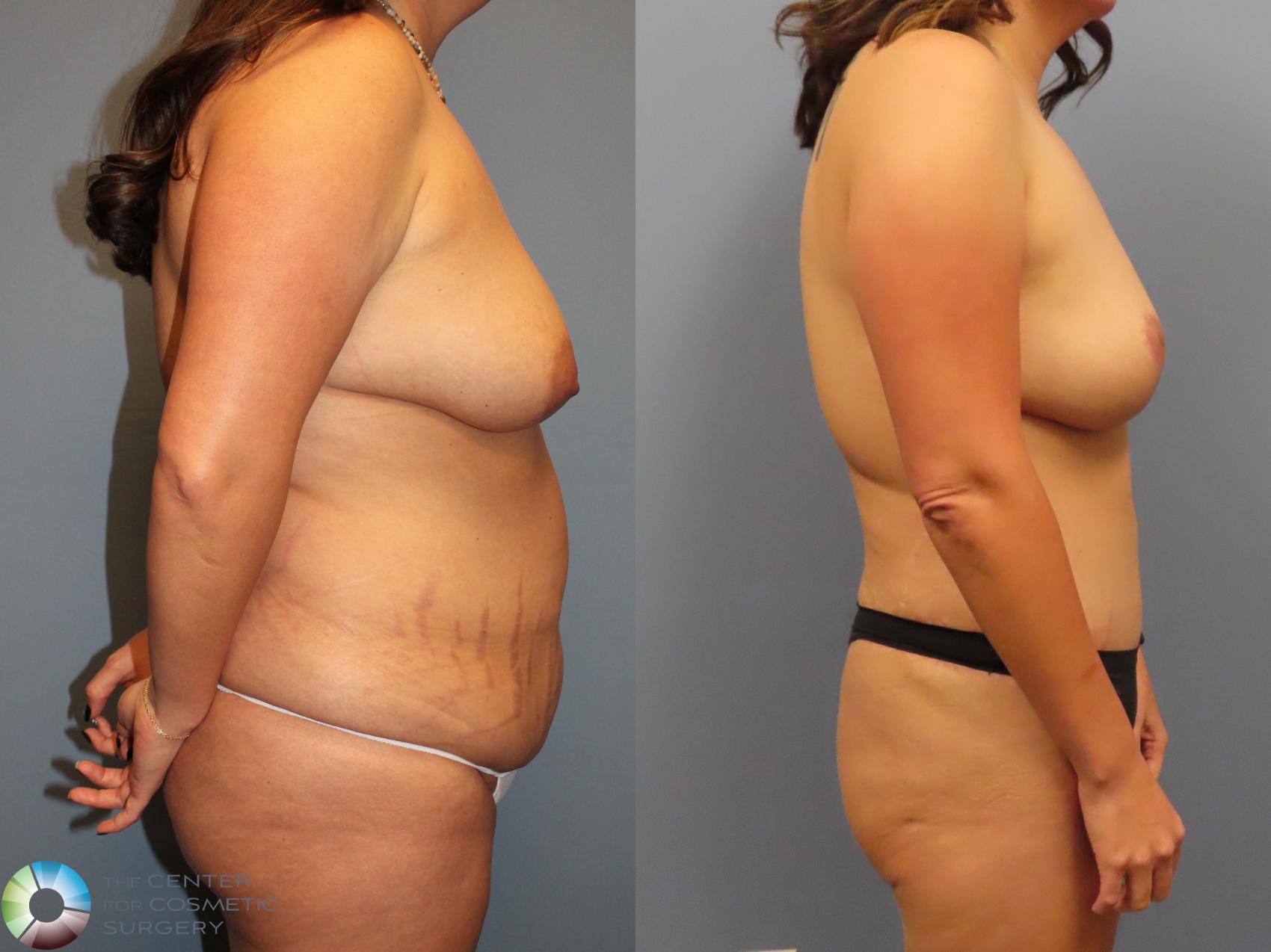 Before & After Mommy Makeover Case 12121 Right Side in Denver and Colorado Springs, CO