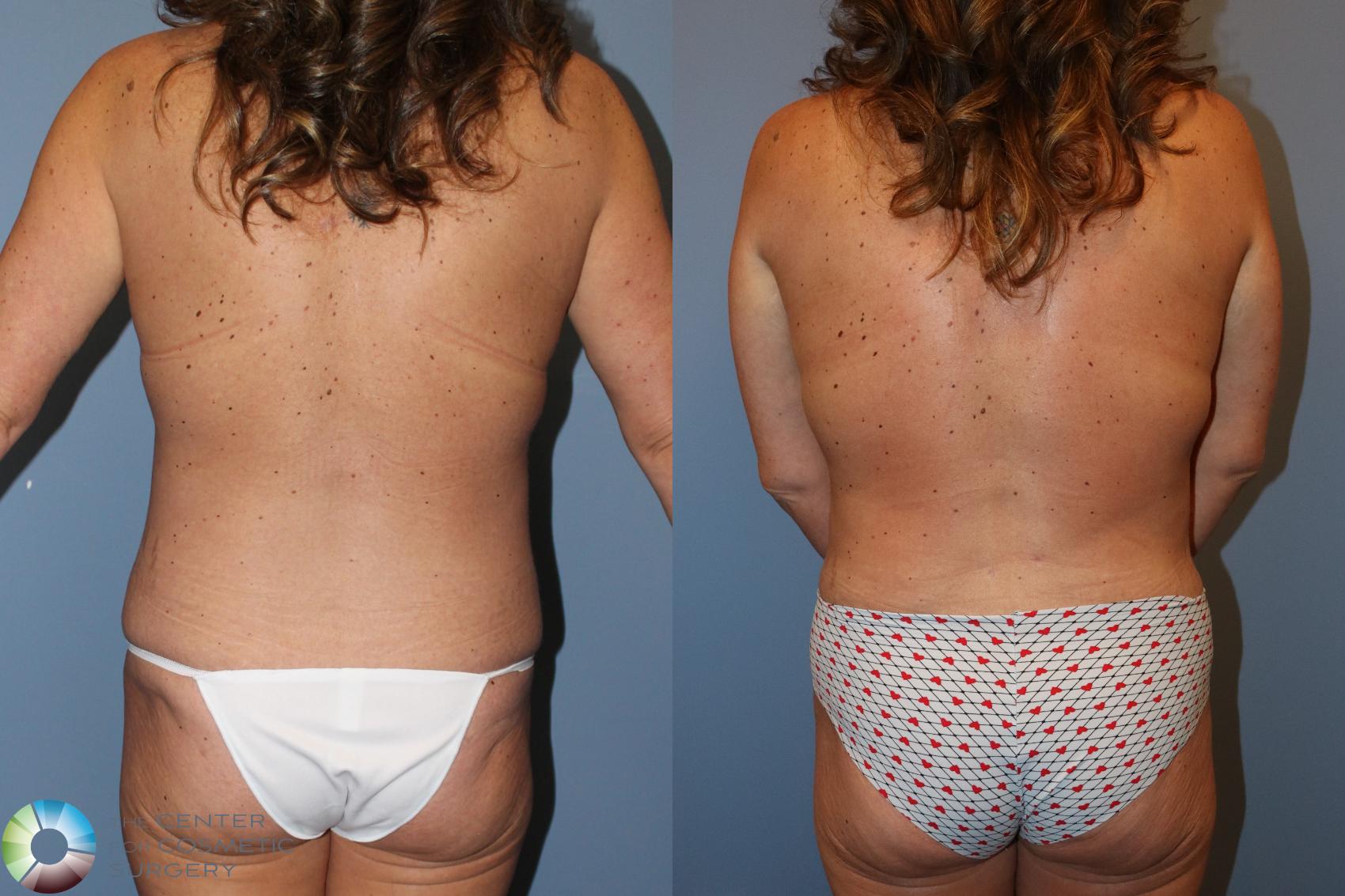 Before & After Mommy Makeover Case 12138 Back in Denver and Colorado Springs, CO