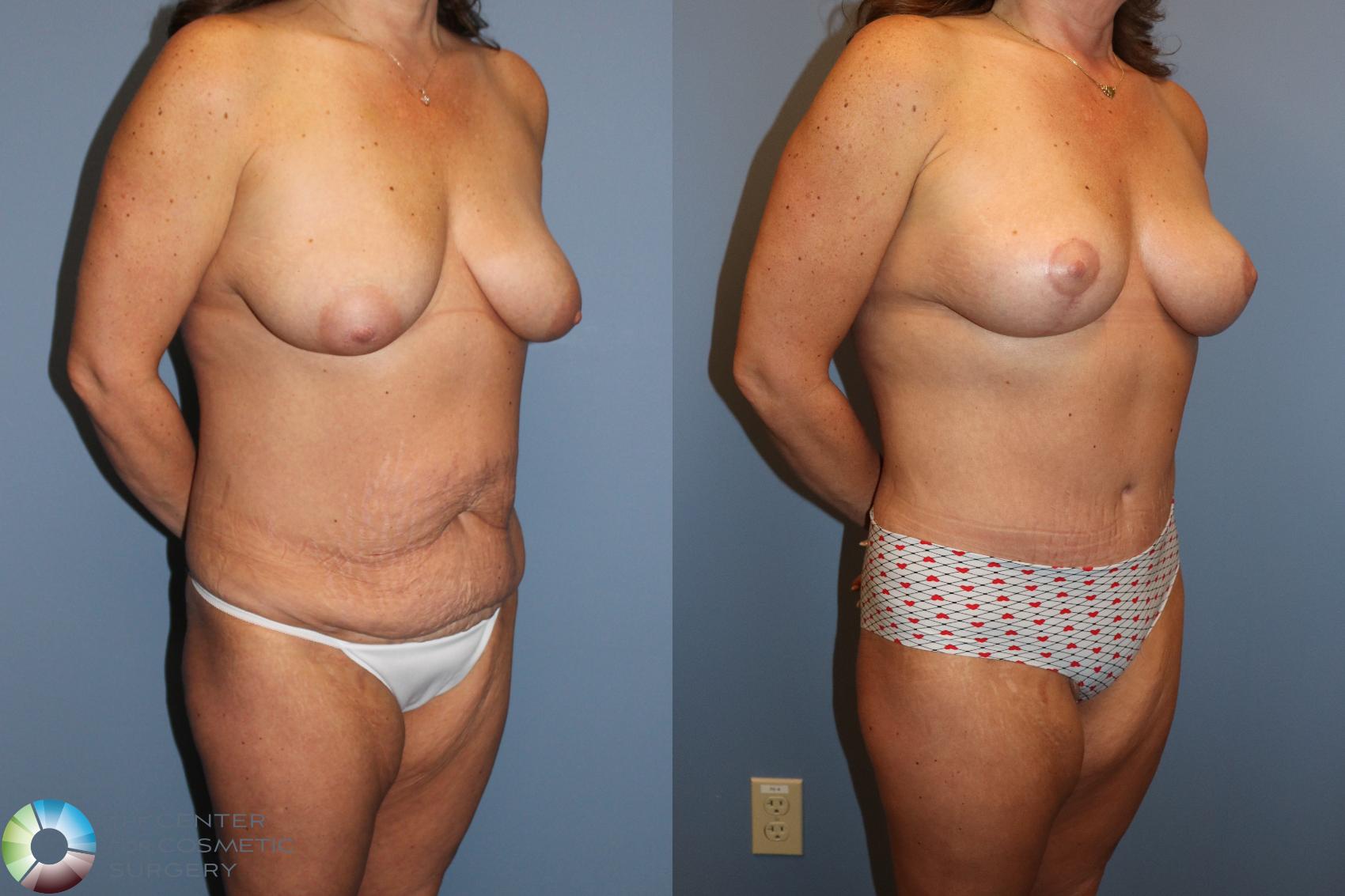 Before & After Mommy Makeover Case 12138 Right Oblique in Denver and Colorado Springs, CO