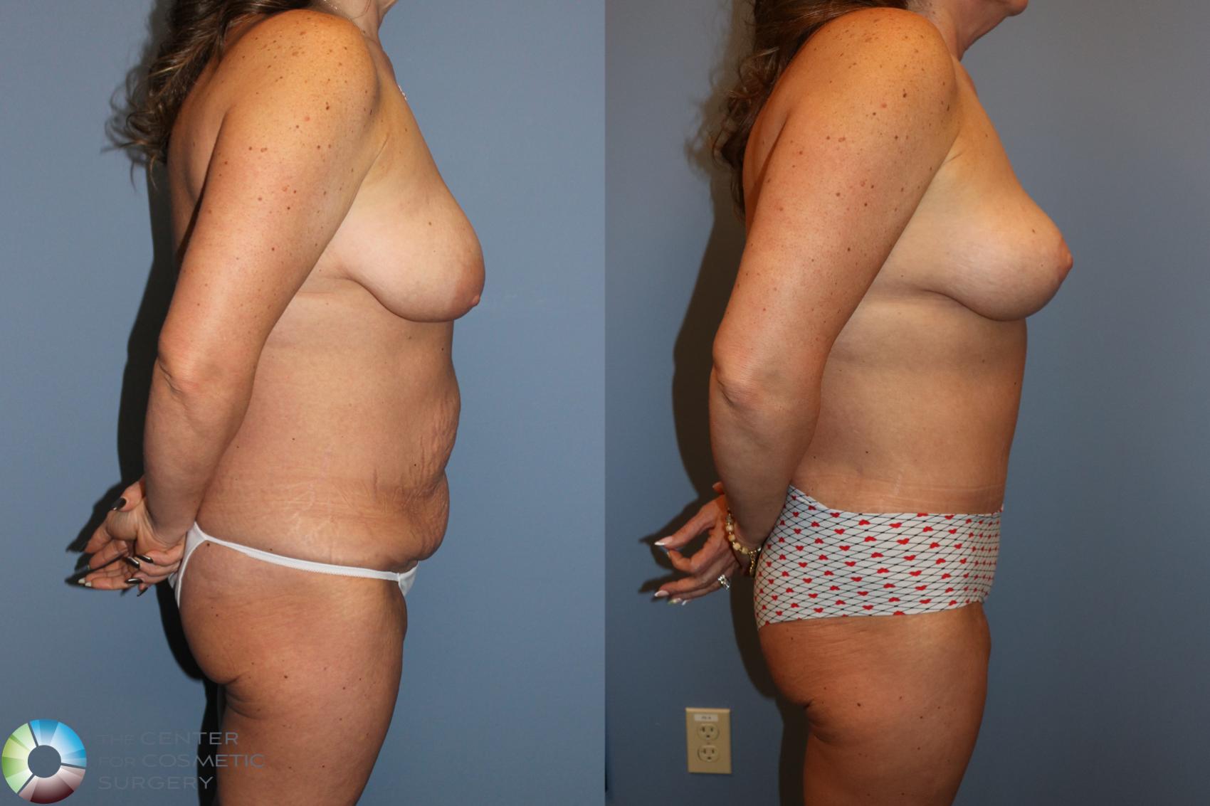 Before & After Mommy Makeover Case 12138 Right Side in Denver and Colorado Springs, CO