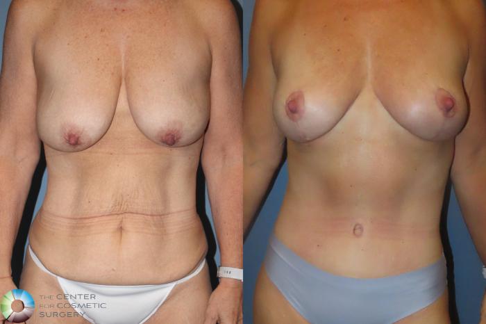 Best Denver Mommy Makeover