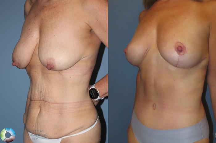 Best Denver Mommy Makeover