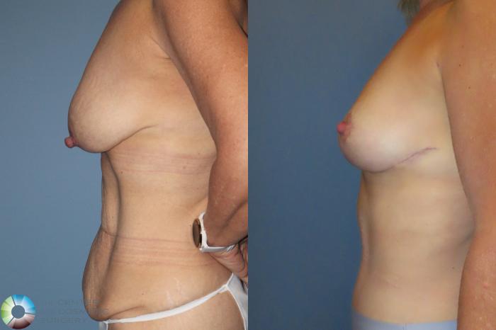 Best Denver Mommy Makeover