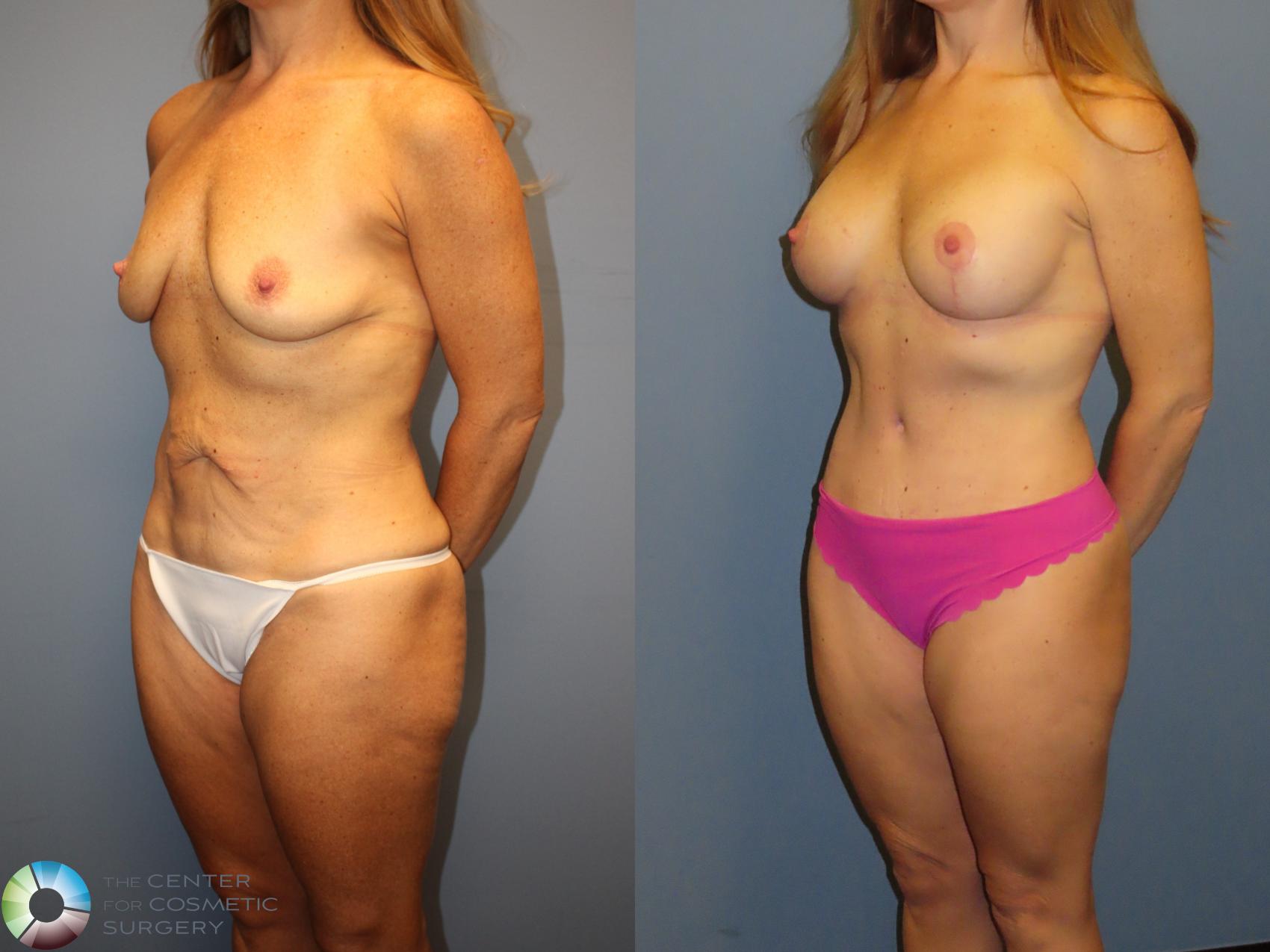 Before & After Mommy Makeover Case 12237 Left Oblique in Denver and Colorado Springs, CO