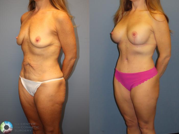 Before & After Mommy Makeover Case 12237 Left Oblique in Denver and Colorado Springs, CO