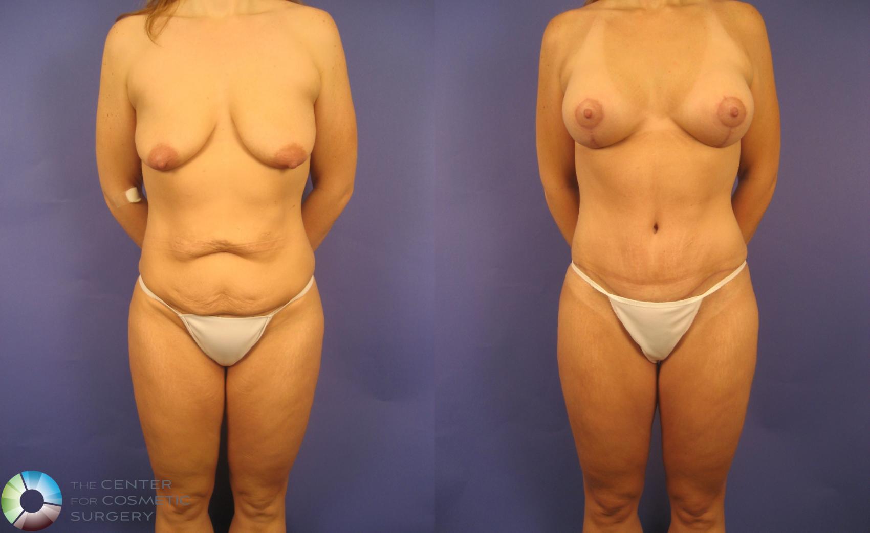Before & After Breast Lift Case 152 View #1 View in Denver & Golden, CO
