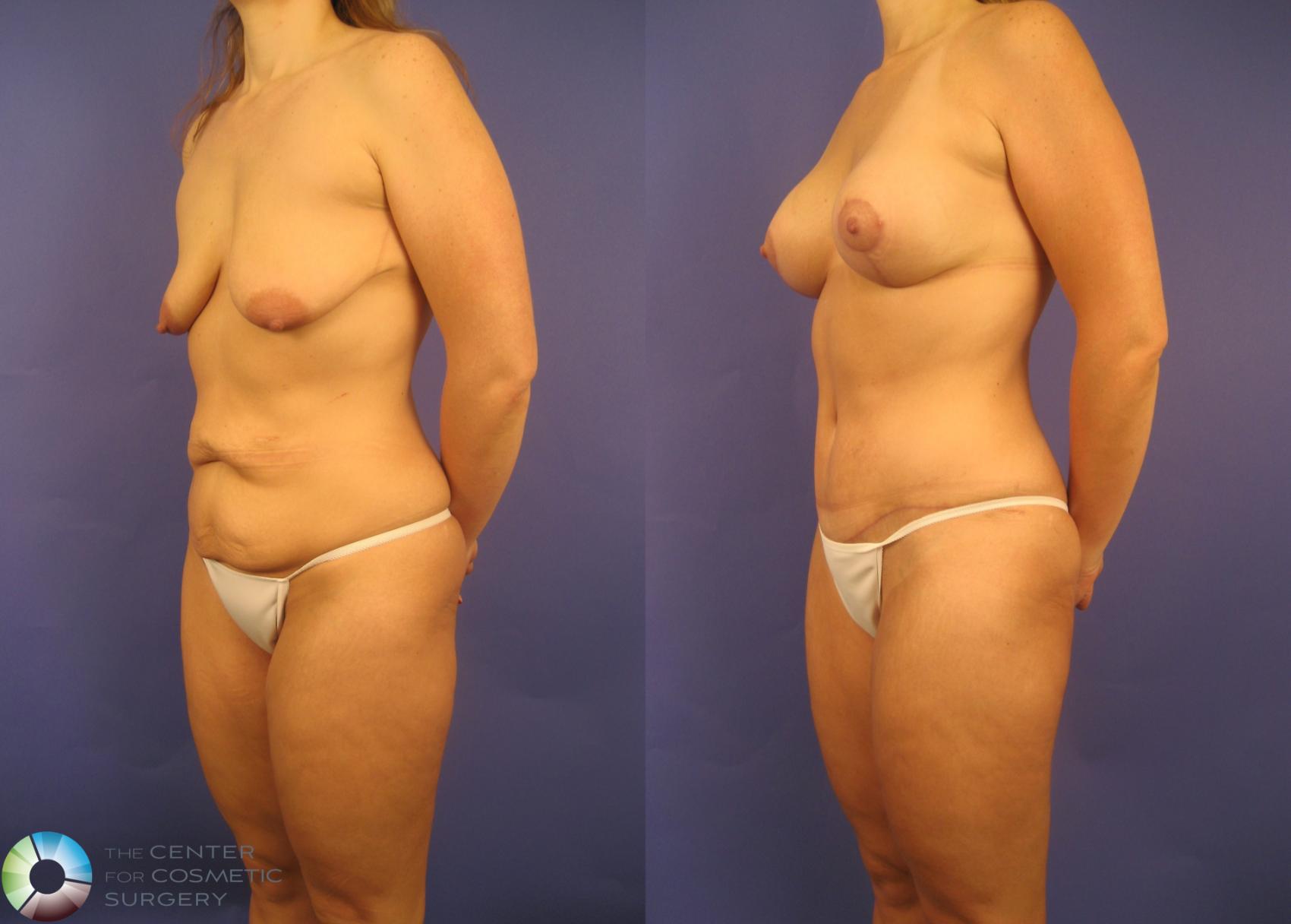 Before & After Mommy Makeover Case 152 View #3 in Denver and Colorado Springs, CO