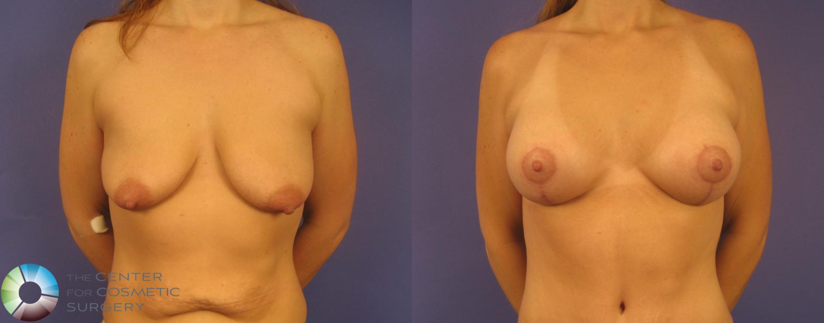 Before & After Mommy Makeover Case 152 View #5 in Denver and Colorado Springs, CO