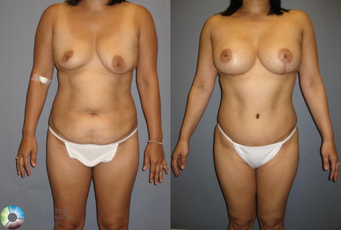 Before & After Breast Augmentation Case 200 View #1 View in Golden, CO