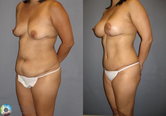 Before & After Breast Augmentation Case 200 View #2 View in Golden, CO