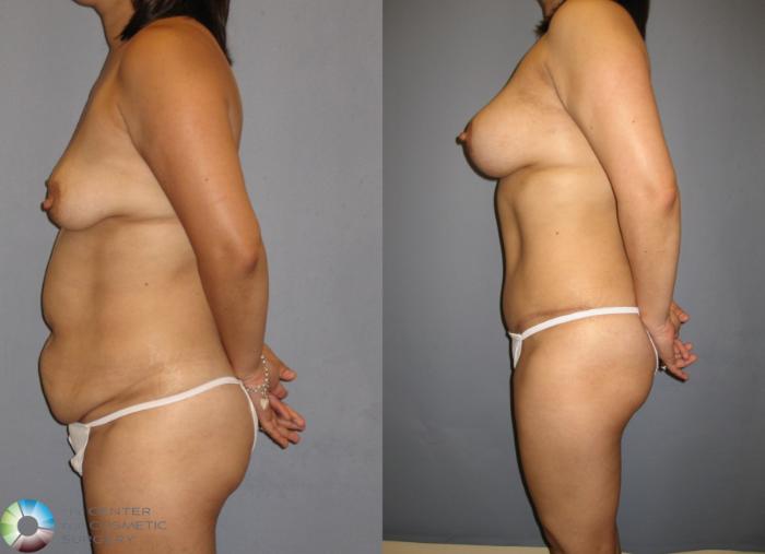 Before & After Breast Augmentation Case 200 View #3 View in Golden, CO