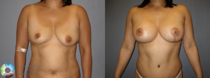Before & After Breast Augmentation Case 200 View #4 View in Golden, CO