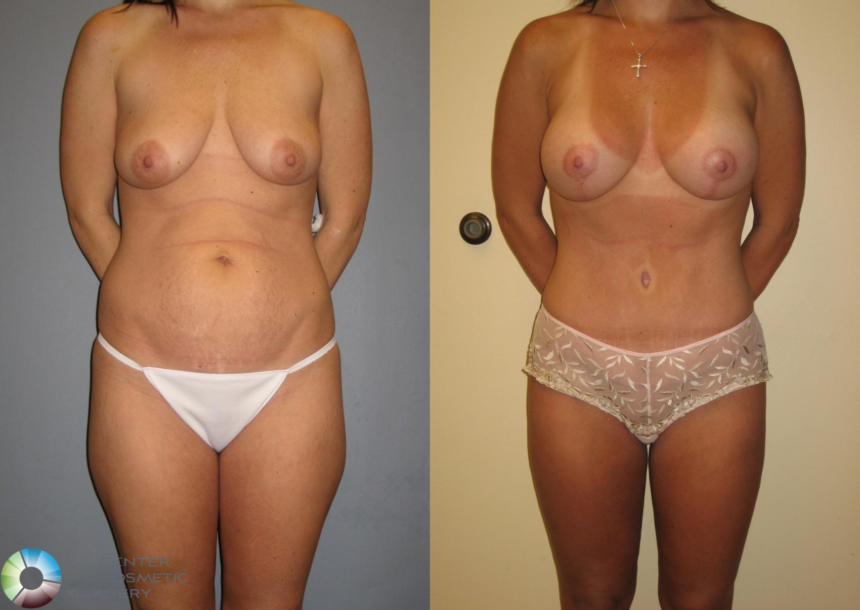 Before & After Mommy Makeover Case 228 View #1 in Denver and Colorado Springs, CO