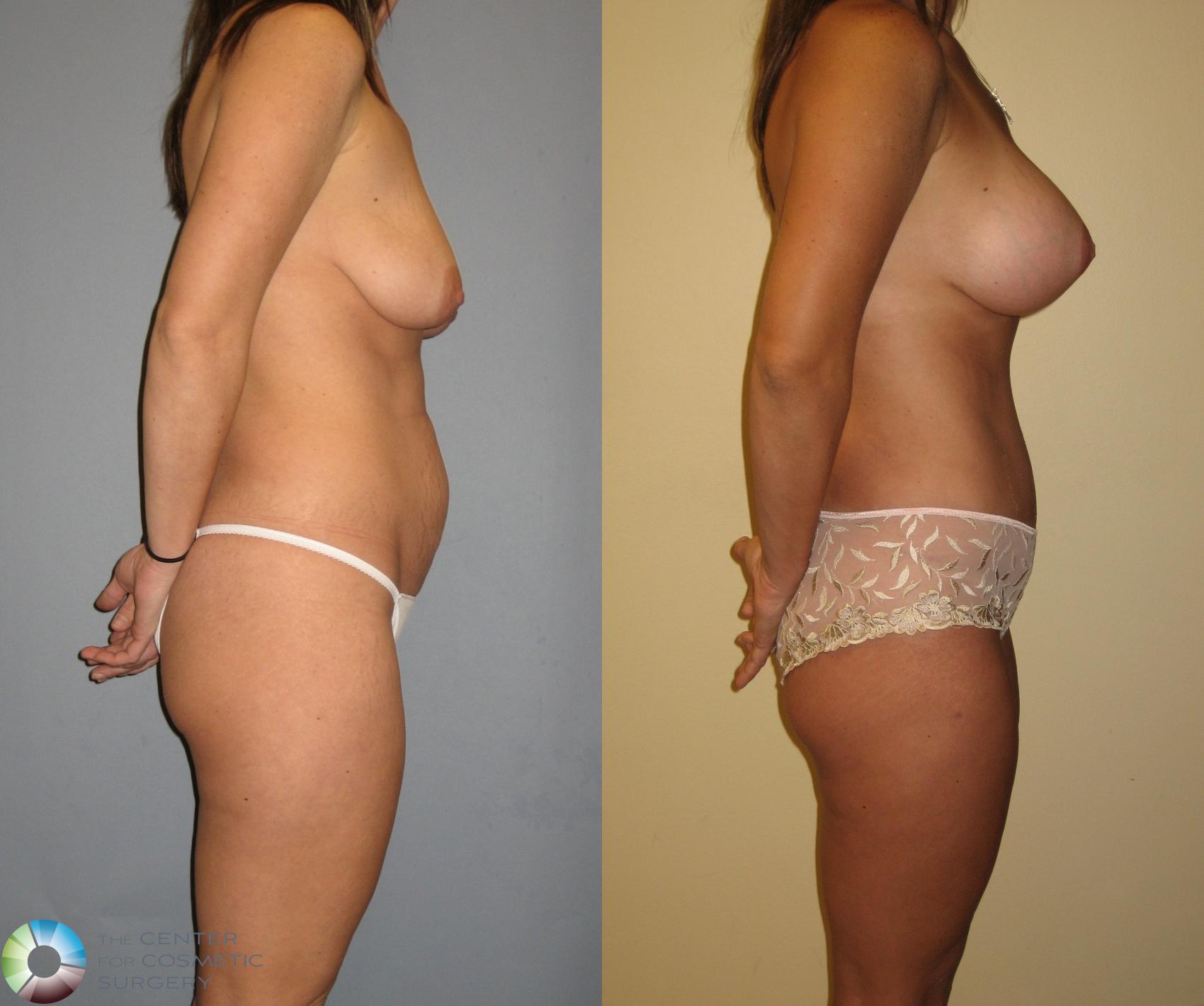 Before & After Mommy Makeover Case 228 View #3 in Denver and Colorado Springs, CO